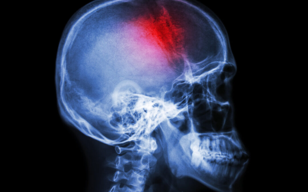 Urazy czaszkowo mózgowe